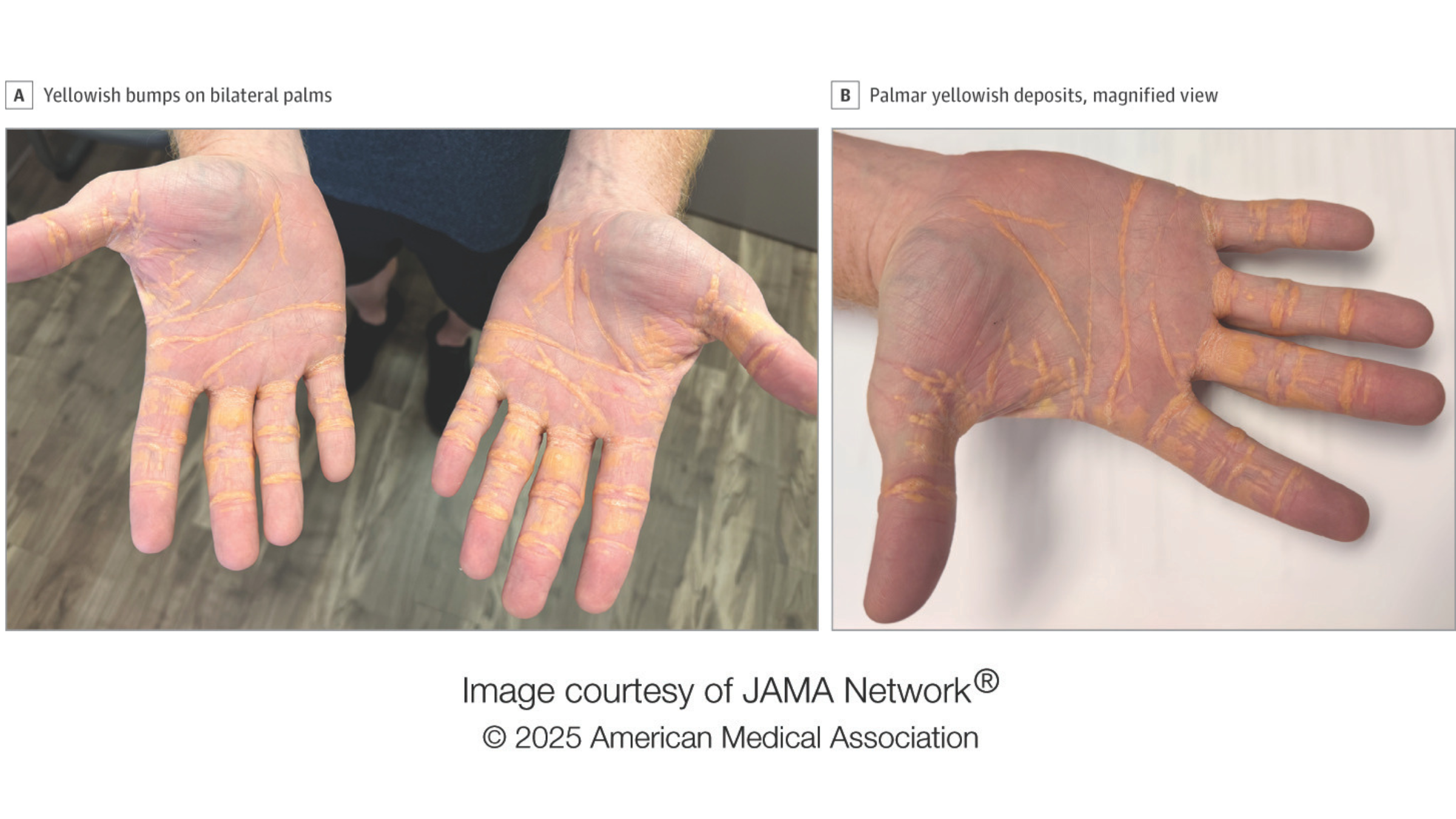 'Carnivore diet' caused yellow lumps to grow on man's hands and feet