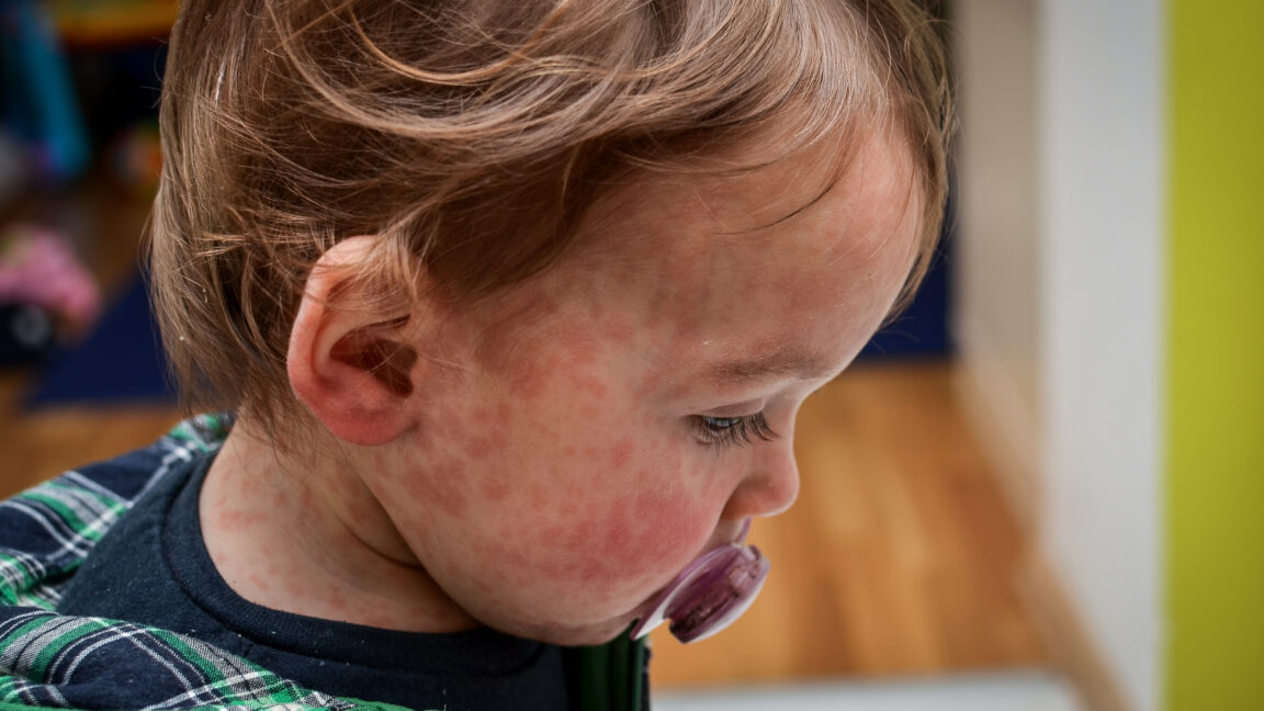 Measles outbreak doubles in one of Texas’ least vaccinated counties