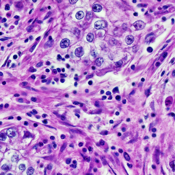 Ai Cancer Diagnostic Bias Lkvogf