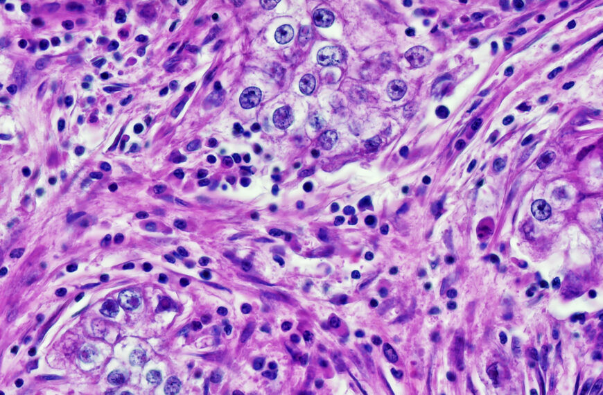 Ai Cancer Diagnostic Bias Lkvogf